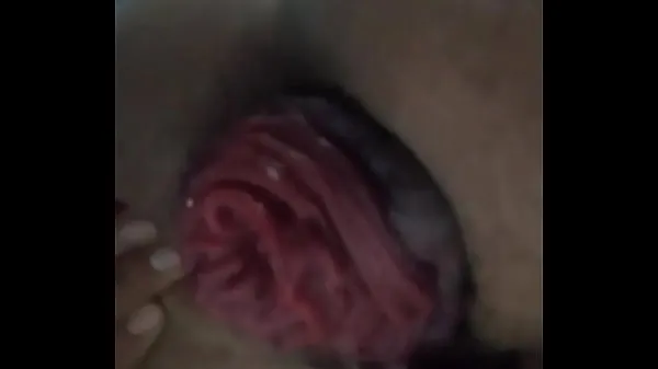 HD Prolapso anal extremo tubo total